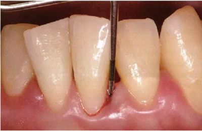 牙周袋深度測定法 牙周袋深度測定法