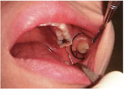 牙周袋深度測定法 牙周袋深度測定法
