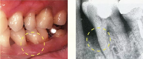 牙周袋深度測定法 牙周袋深度測定法