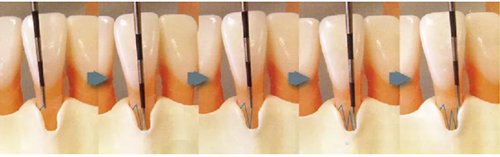 牙周袋深度測定法 牙周袋深度測定法