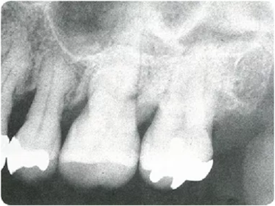 牙周袋深度測定法 牙周袋深度測定法