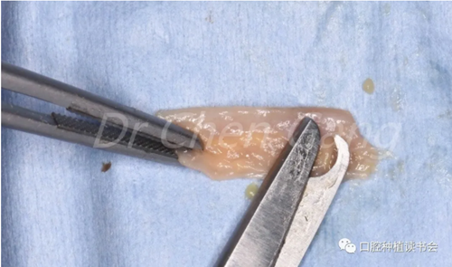 高清圖解|游離牙齦(FGG)的獲取與移植技術(shù) 高清圖解|游離牙齦(FGG)的獲取與移植技術(shù)