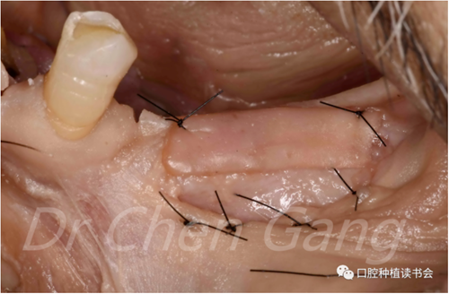 高清圖解|游離牙齦(FGG)的獲取與移植技術(shù) 高清圖解|游離牙齦(FGG)的獲取與移植技術(shù)