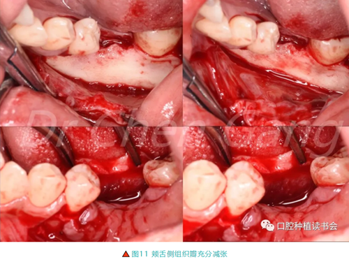 高清圖解|游離牙齦(FGG)的獲取與移植技術(shù) 高清圖解|游離牙齦(FGG)的獲取與移植技術(shù)