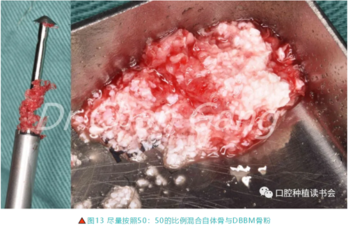 高清圖解|游離牙齦(FGG)的獲取與移植技術(shù) 高清圖解|游離牙齦(FGG)的獲取與移植技術(shù)