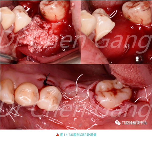 高清圖解|游離牙齦(FGG)的獲取與移植技術(shù) 高清圖解|游離牙齦(FGG)的獲取與移植技術(shù)