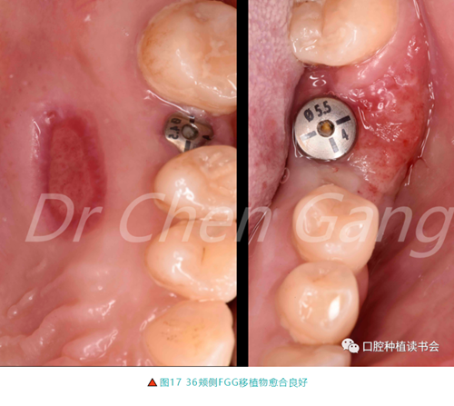 高清圖解|游離牙齦(FGG)的獲取與移植技術(shù) 高清圖解|游離牙齦(FGG)的獲取與移植技術(shù)