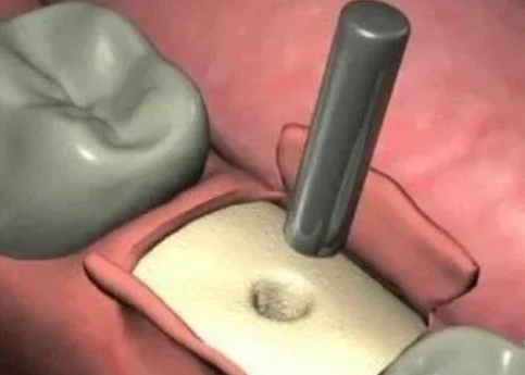 最詳細(xì)的種植牙流程 最詳細(xì)的種植牙流程