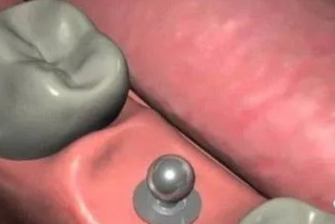 最詳細(xì)的種植牙流程 最詳細(xì)的種植牙流程