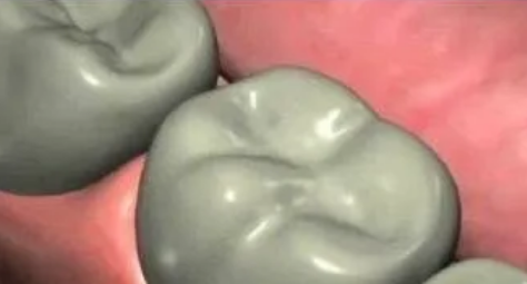 最詳細(xì)的種植牙流程 最詳細(xì)的種植牙流程