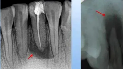 各類根尖周病的X片表現(xiàn) 各類根尖周病的X片表現(xiàn)