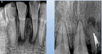 各類根尖周病的X片表現(xiàn) 各類根尖周病的X片表現(xiàn)