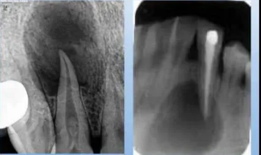 各類根尖周病的X片表現(xiàn) 各類根尖周病的X片表現(xiàn)