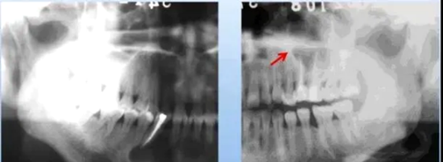 各類根尖周病的X片表現(xiàn) 各類根尖周病的X片表現(xiàn)