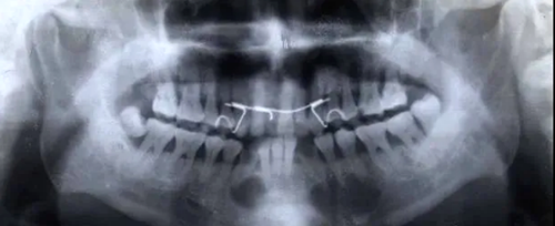 各類根尖周病的X片表現(xiàn) 各類根尖周病的X片表現(xiàn)