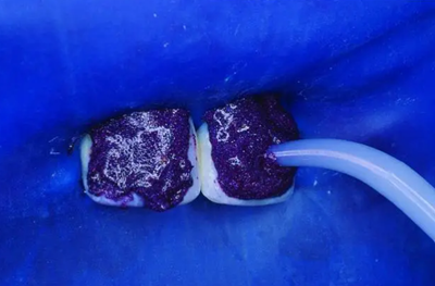 氟斑牙的克星--美國皓齒微創(chuàng)治療法 氟斑牙的克星--美國皓齒微創(chuàng)治療法