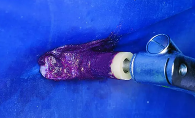 氟斑牙的克星--美國皓齒微創(chuàng)治療法 氟斑牙的克星--美國皓齒微創(chuàng)治療法