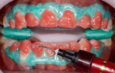 氟斑牙的克星--美國皓齒微創(chuàng)治療法 氟斑牙的克星--美國皓齒微創(chuàng)治療法