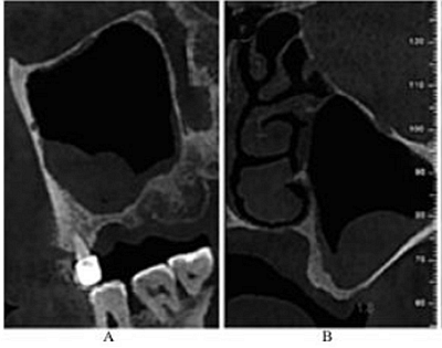 上頜竇外提 上頜竇外提