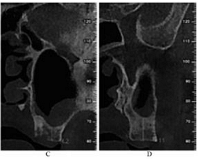 上頜竇外提 上頜竇外提