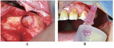 上頜竇外提 上頜竇外提