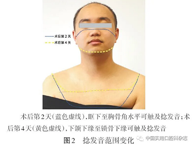 病例報(bào)告 | 下頜第三磨牙拔除術(shù)后并發(fā)雙側(cè)廣泛性皮下氣腫及縱隔氣腫1例報(bào)告 病例報(bào)告 | 下頜第三磨牙拔除術(shù)后并發(fā)雙側(cè)廣泛性皮下氣腫及縱隔氣腫1例報(bào)告