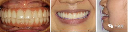 【病例分享】應用全程數(shù)字化對牙周炎患者實現(xiàn)全口即刻種植即刻修復