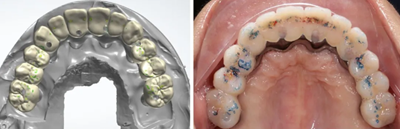 【病例分享】應用全程數(shù)字化對牙周炎患者實現(xiàn)全口即刻種植即刻修復