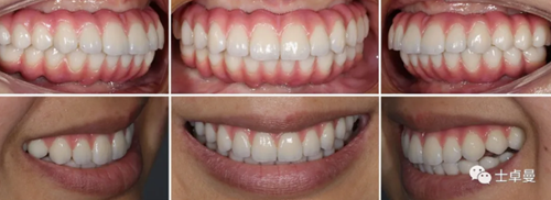 【病例分享】應用全程數(shù)字化對牙周炎患者實現(xiàn)全口即刻種植即刻修復