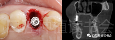 后牙區(qū)即刻種植臨床指南 后牙區(qū)即刻種植臨床指南