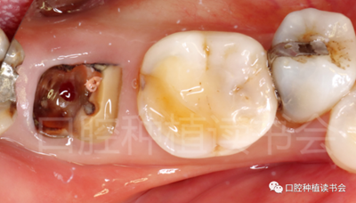 后牙區(qū)即刻種植臨床指南 后牙區(qū)即刻種植臨床指南