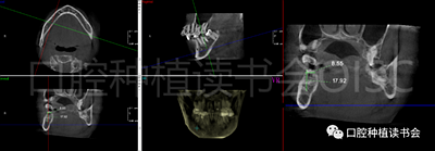 后牙區(qū)即刻種植臨床指南 后牙區(qū)即刻種植臨床指南