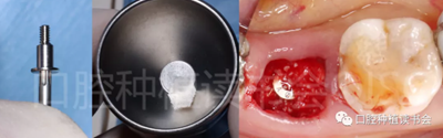 后牙區(qū)即刻種植臨床指南 后牙區(qū)即刻種植臨床指南