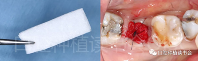 后牙區(qū)即刻種植臨床指南 后牙區(qū)即刻種植臨床指南