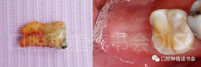 后牙區(qū)即刻種植臨床指南 后牙區(qū)即刻種植臨床指南