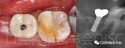 后牙區(qū)即刻種植臨床指南 后牙區(qū)即刻種植臨床指南