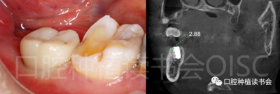 后牙區(qū)即刻種植臨床指南 后牙區(qū)即刻種植臨床指南