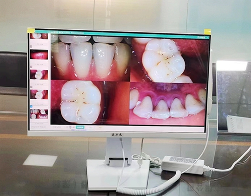 美力光口腔觀(guān)察儀內(nèi)窺鏡 美力光口腔觀(guān)察儀內(nèi)窺鏡