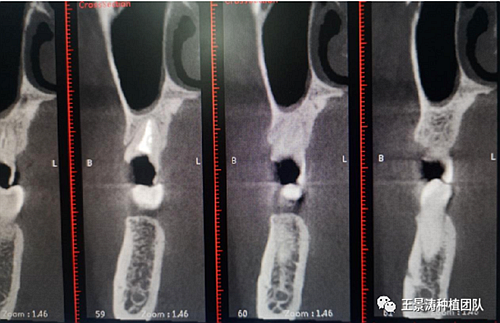 后牙區(qū)即刻種植的適應(yīng)癥的思考 后牙區(qū)即刻種植的適應(yīng)癥的思考