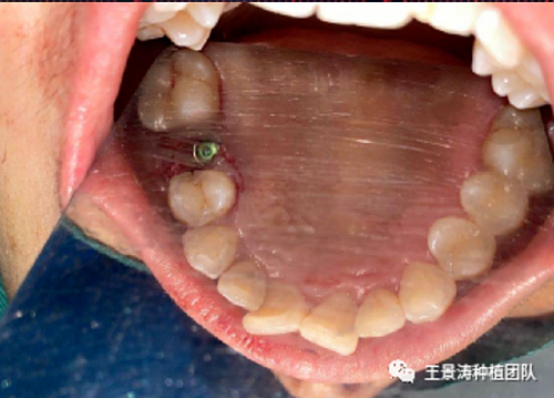 后牙區(qū)即刻種植的適應(yīng)癥的思考 后牙區(qū)即刻種植的適應(yīng)癥的思考