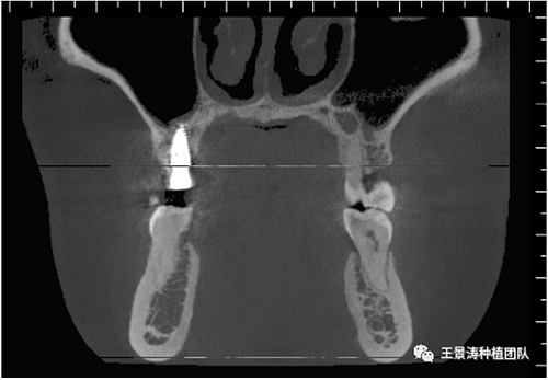 后牙區(qū)即刻種植的適應(yīng)癥的思考 后牙區(qū)即刻種植的適應(yīng)癥的思考