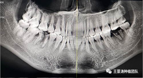 后牙區(qū)即刻種植的適應(yīng)癥的思考 后牙區(qū)即刻種植的適應(yīng)癥的思考