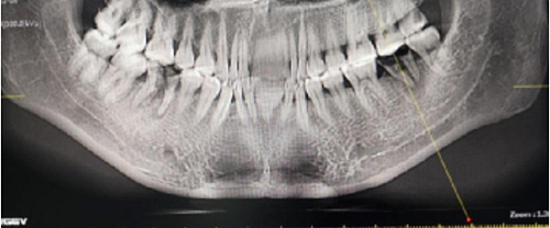 后牙區(qū)即刻種植的適應(yīng)癥的思考 后牙區(qū)即刻種植的適應(yīng)癥的思考