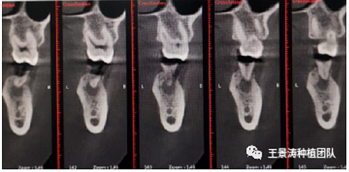 后牙區(qū)即刻種植的適應(yīng)癥的思考 后牙區(qū)即刻種植的適應(yīng)癥的思考