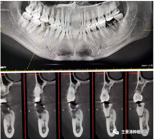 后牙區(qū)即刻種植的適應(yīng)癥的思考 后牙區(qū)即刻種植的適應(yīng)癥的思考