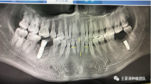 后牙區(qū)即刻種植的適應(yīng)癥的思考 后牙區(qū)即刻種植的適應(yīng)癥的思考
