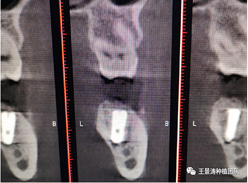 后牙區(qū)即刻種植的適應(yīng)癥的思考 后牙區(qū)即刻種植的適應(yīng)癥的思考