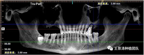 后牙區(qū)即刻種植的適應(yīng)癥的思考 后牙區(qū)即刻種植的適應(yīng)癥的思考