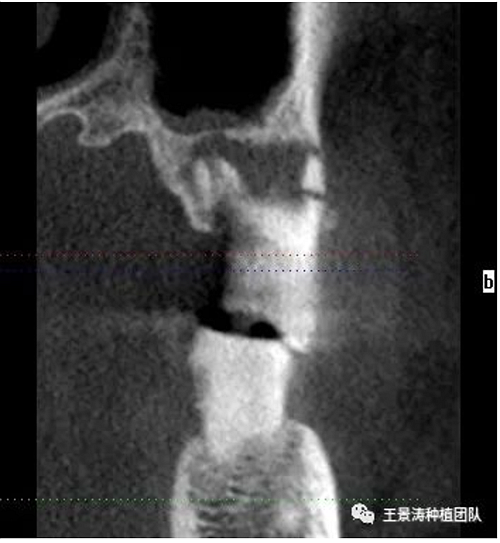 后牙區(qū)即刻種植的適應(yīng)癥的思考 后牙區(qū)即刻種植的適應(yīng)癥的思考