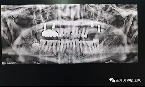 后牙區(qū)即刻種植的適應(yīng)癥的思考 后牙區(qū)即刻種植的適應(yīng)癥的思考